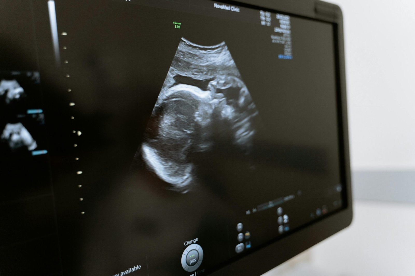 Ultrasound screen