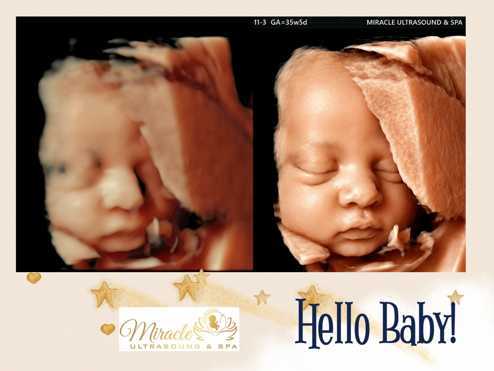 3D and 4D baby ultrasound image at Miracle Ultrasound & Spa in Gainesville, VA