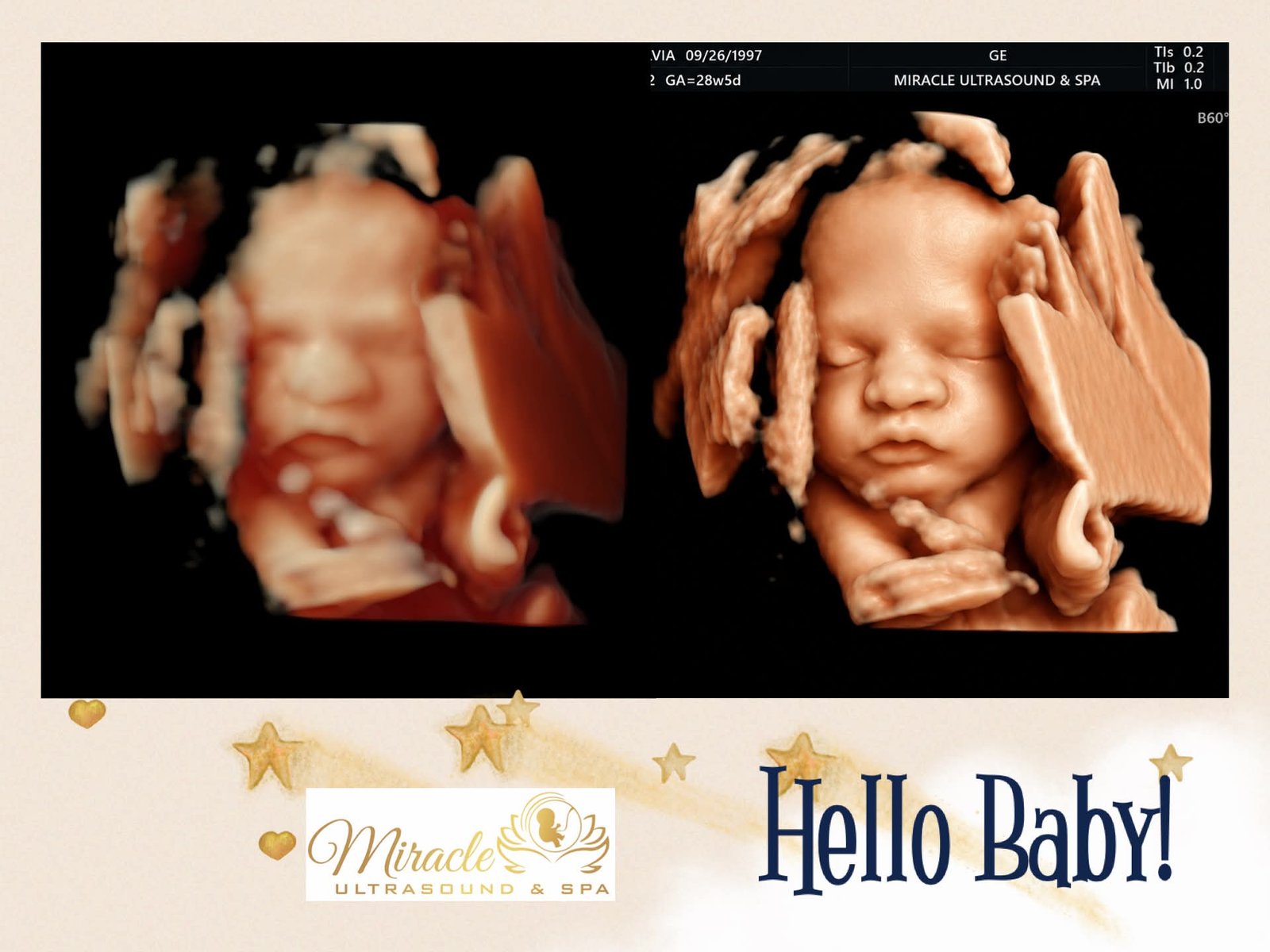Baby's face in 3D ultrasound 