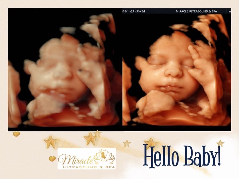 What Makes a Great 4D Ultrasound Video? Movements Families Love to Capture 3 IMG 2385
