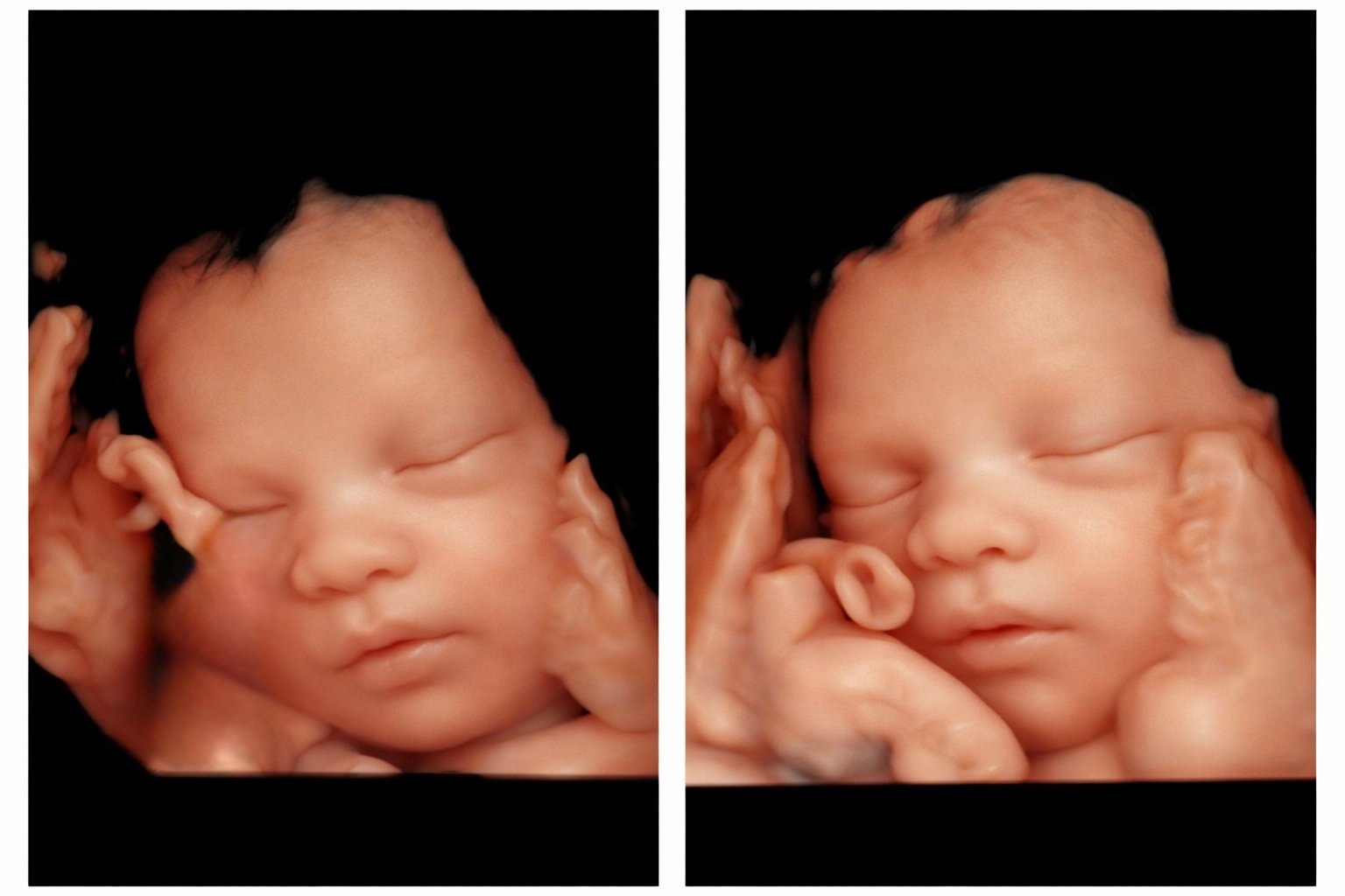 miracle-ultrasound-and-spa-baby-ultrasound-before-and-after-1