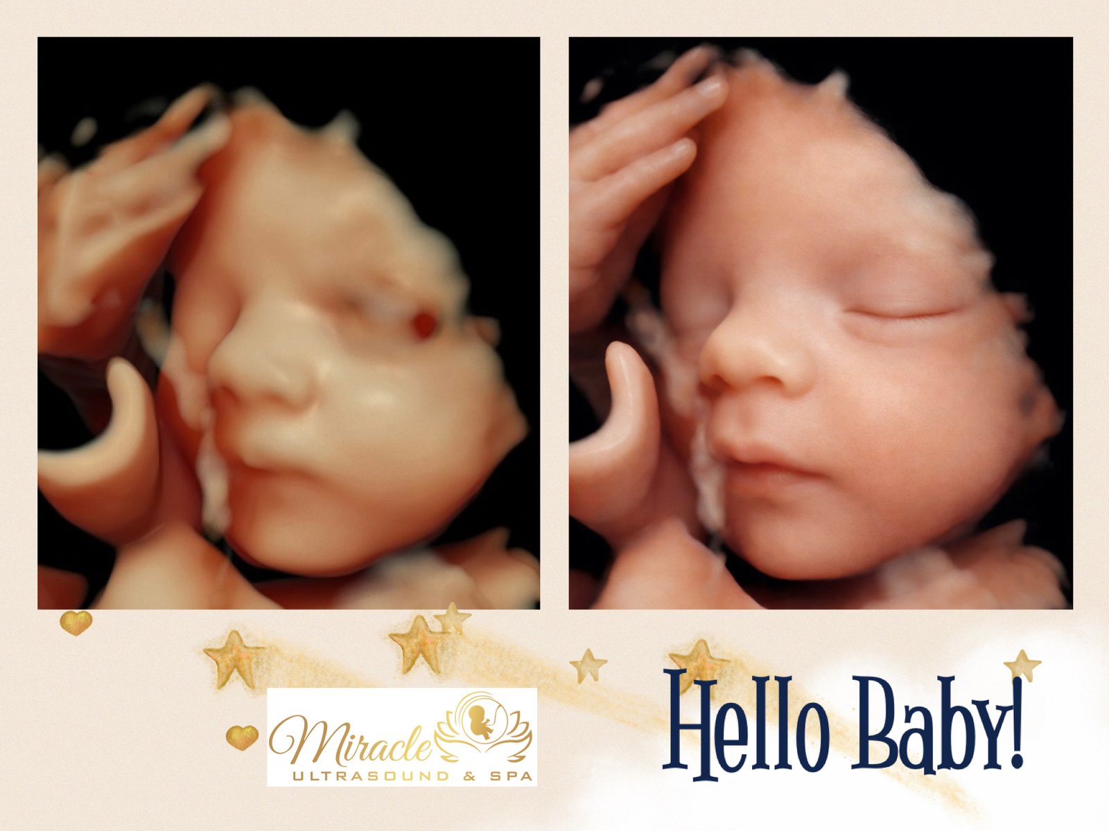 miracle-ultrasound-and-spa-baby-ultrasound-before-and-after-10