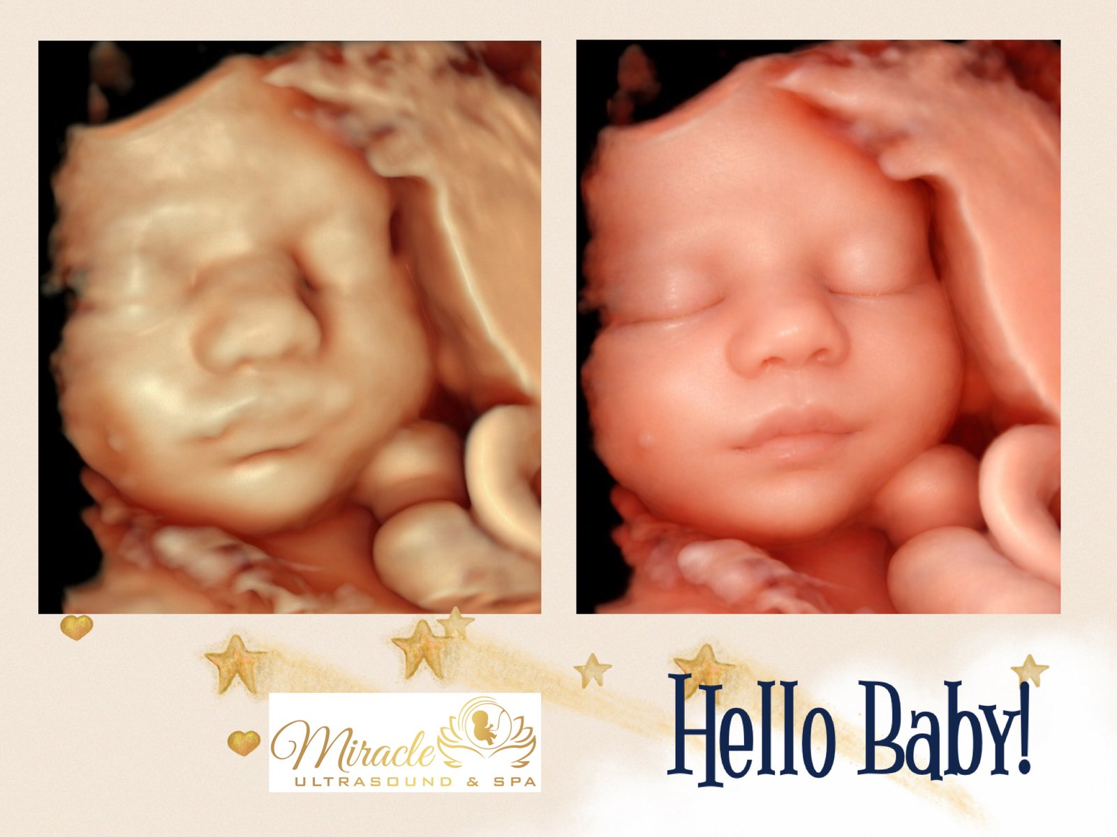 miracle-ultrasound-and-spa-baby-ultrasound-before-and-after-13