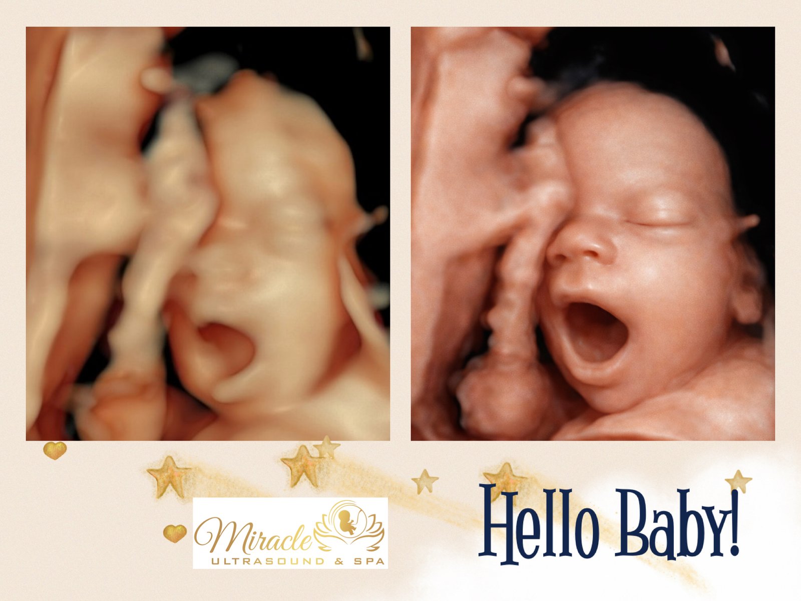 miracle-ultrasound-and-spa-baby-ultrasound-before-and-after-14