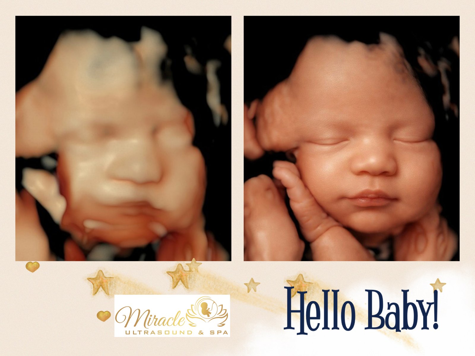 miracle-ultrasound-and-spa-baby-ultrasound-before-and-after-15