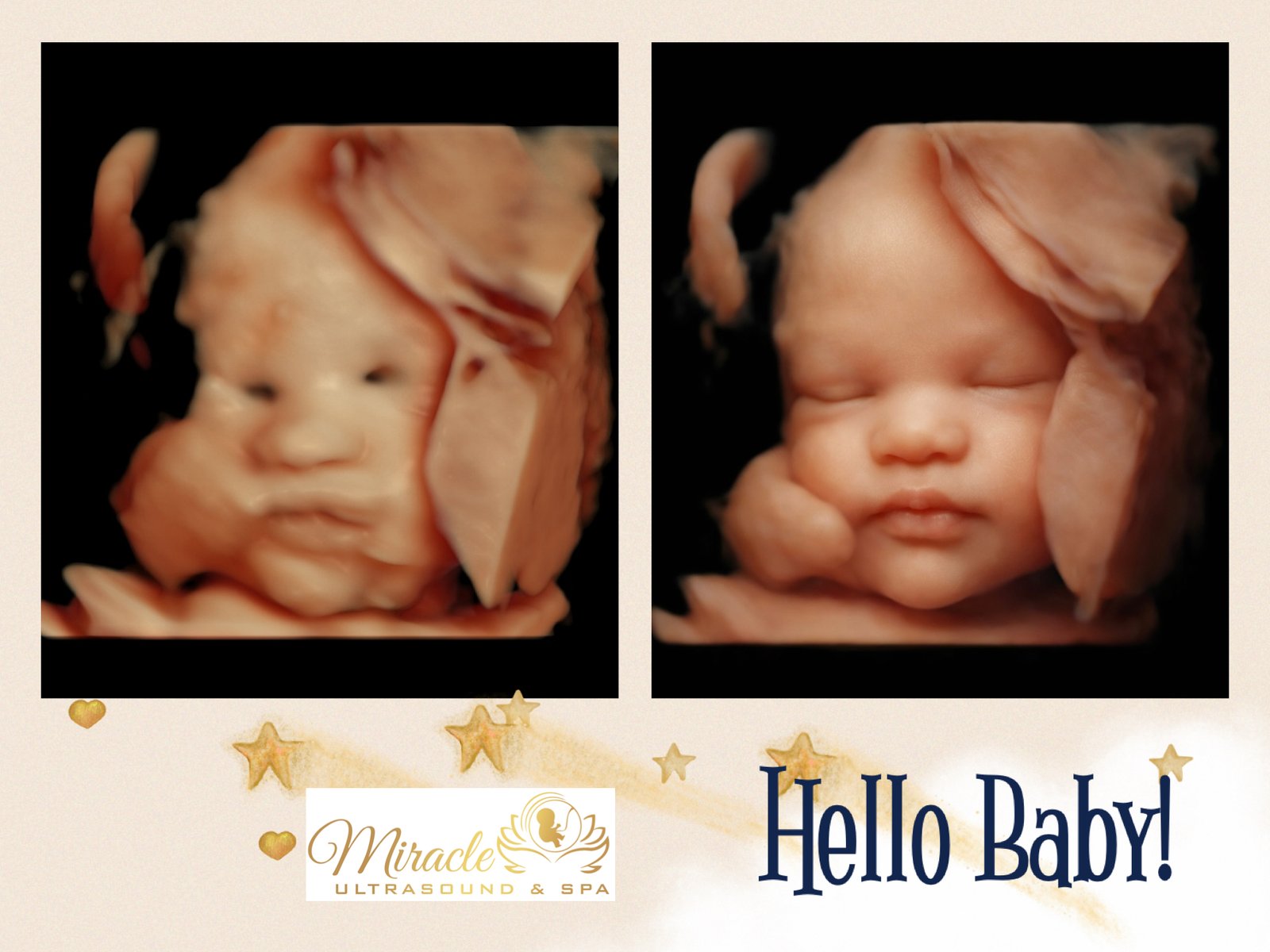 miracle ultrasound and spa baby ultrasound before and after 42