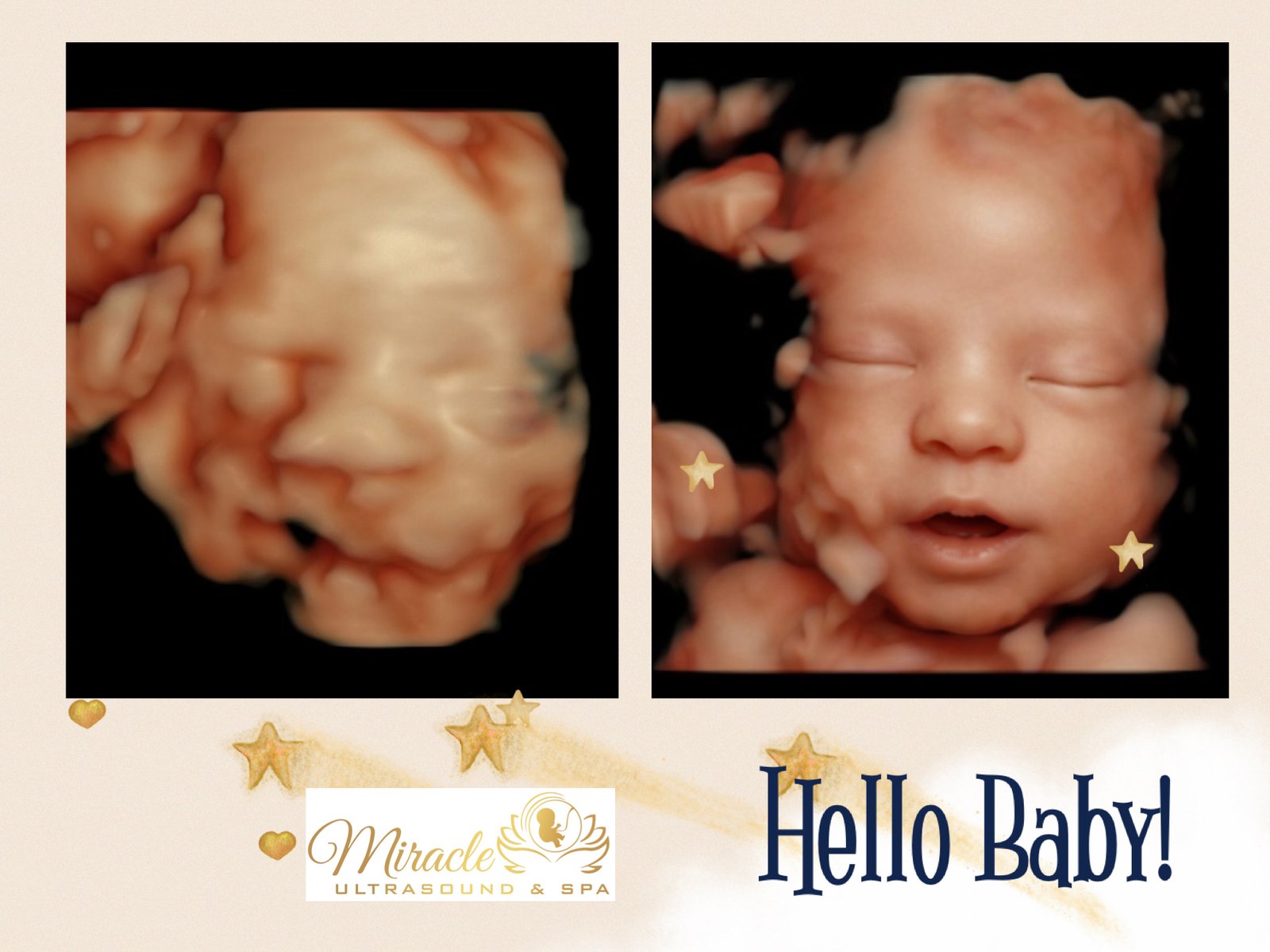 miracle-ultrasound-and-spa-baby-ultrasound-before-and-after-7