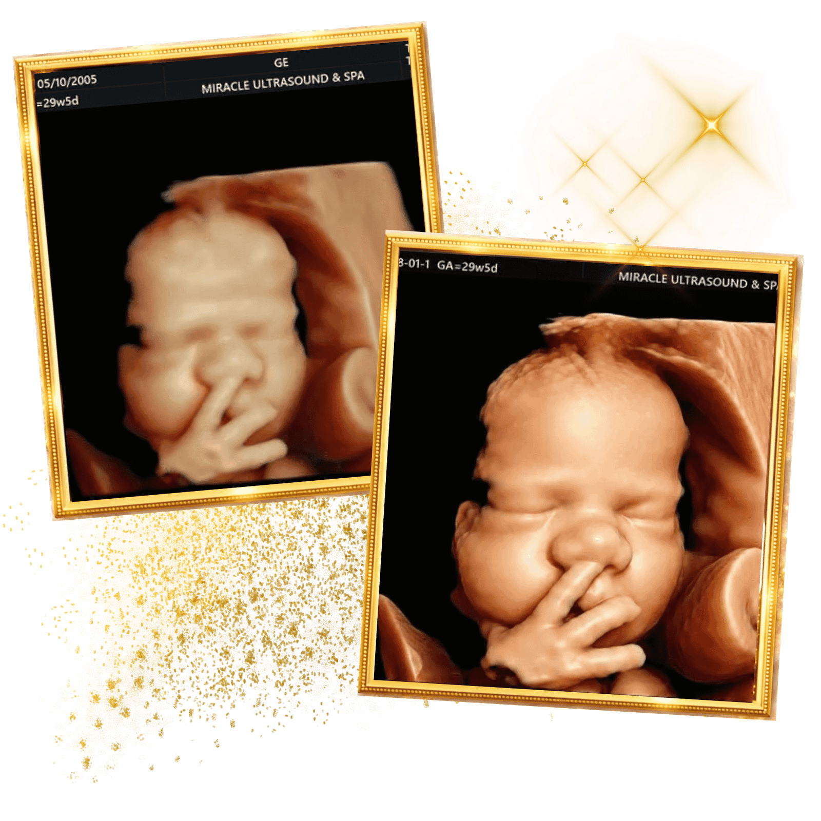 Home 3 miracle-ultrasound-spa-beforeand-after-baby-ultrasound7