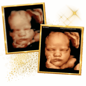 miracle-ultrasound-spa-beforeand-after-baby-ultrasound8