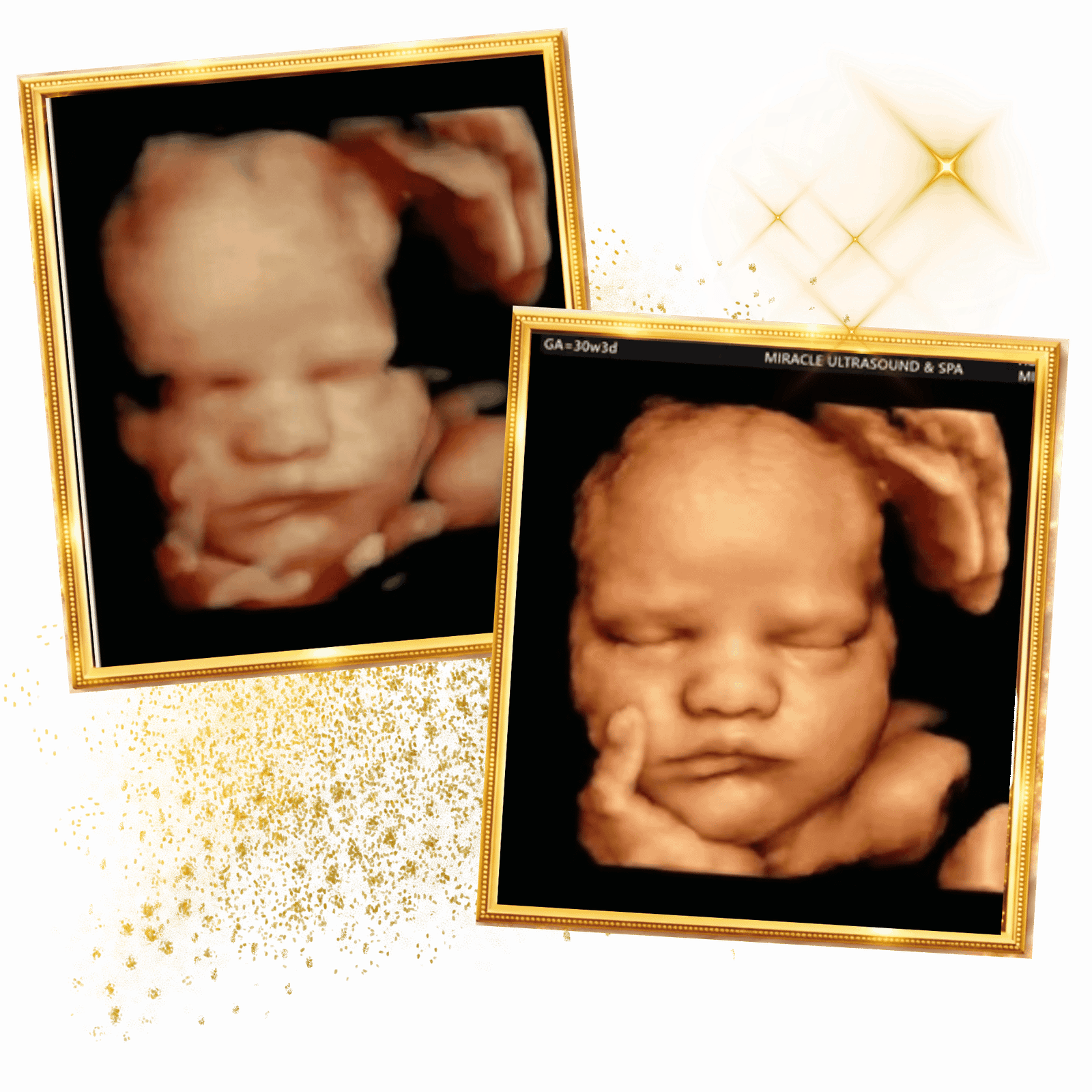 Home 4 miracle-ultrasound-spa-beforeand-after-baby-ultrasound8